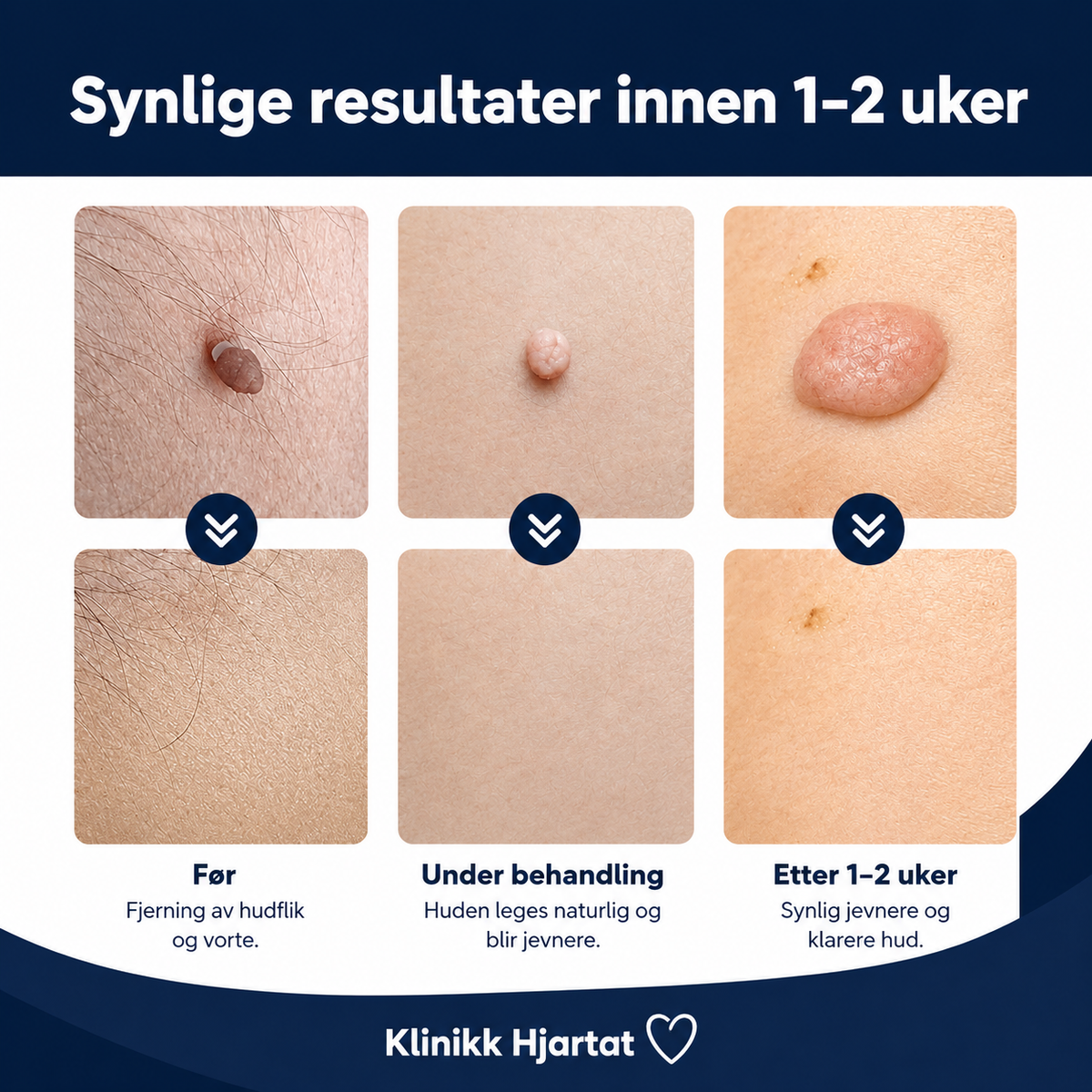 Hudflikfjerner for hjemmebruk – komplett sett for målrettet påføring